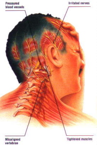 pritisak u glavi zbog vratne kralježnice